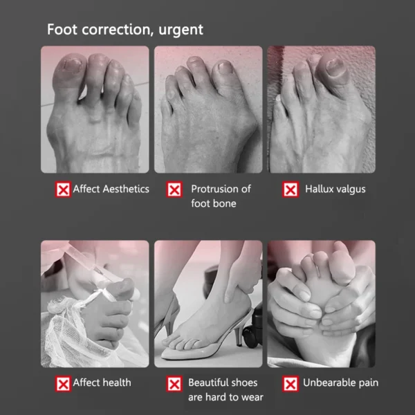 ⁦Bone Thumb Adjuster Orthotics Toe Straightener Foot Care⁩ - الصورة ⁦3⁩